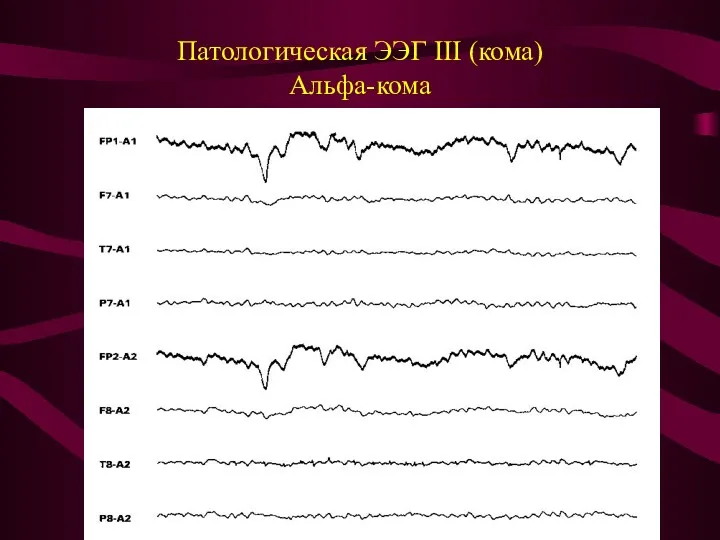 Патологическая ЭЭГ III (кома) Альфа-кома