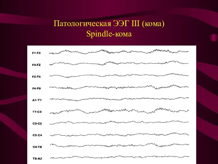 Патологическая ЭЭГ III (кома) Spindle-кома
