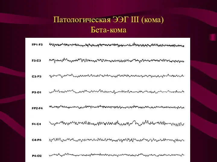 Патологическая ЭЭГ III (кома) Бета-кома