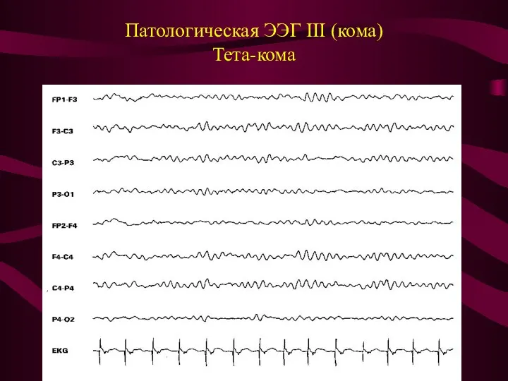 Патологическая ЭЭГ III (кома) Тета-кома