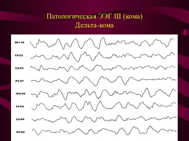 Патологическая ЭЭГ III (кома) Дельта-кома