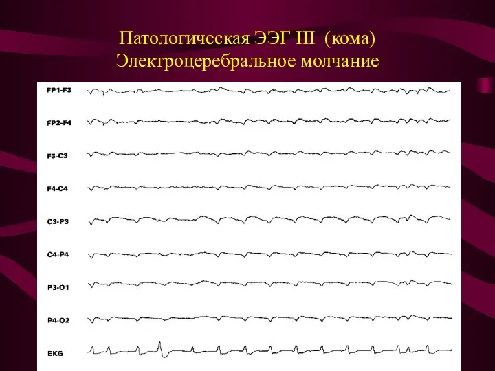 Патологическая ЭЭГ III (кома) Электроцеребральное молчание