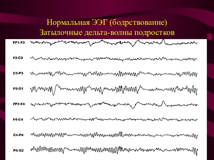 Нормальная ЭЭГ (бодрствование) Затылочные дельта-волны подростков