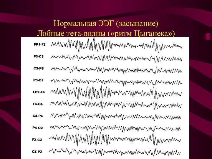 Нормальная ЭЭГ (засыпание) Лобные тета-волны («ритм Цыганека»)