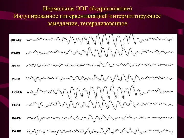 Нормальная ЭЭГ (бодрствование) Индуцированное гипервентиляцией интермиттирующее замедление, генерализованное