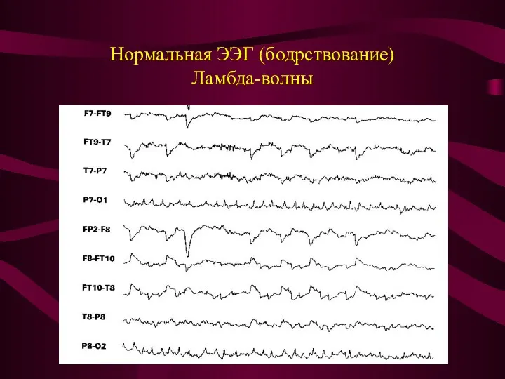 Нормальная ЭЭГ (бодрствование) Ламбда-волны