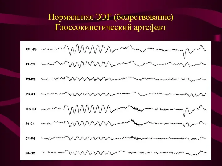 Нормальная ЭЭГ (бодрствование) Глоссокинетический артефакт