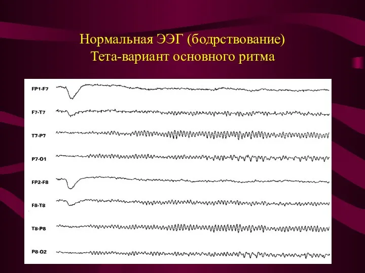 Нормальная ЭЭГ (бодрствование) Тета-вариант основного ритма