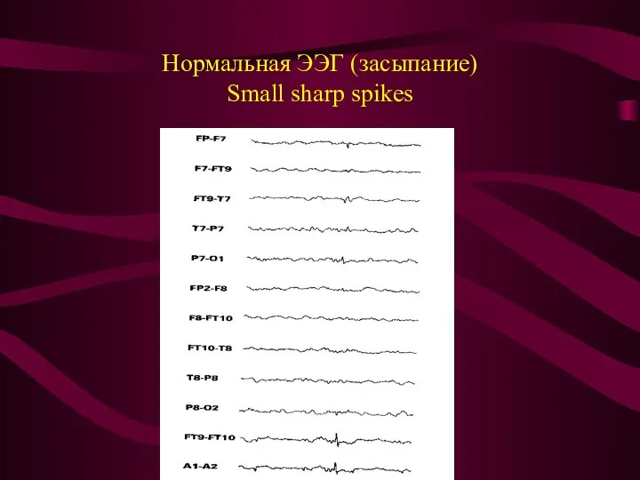 Нормальная ЭЭГ (засыпание) Small sharp spikes