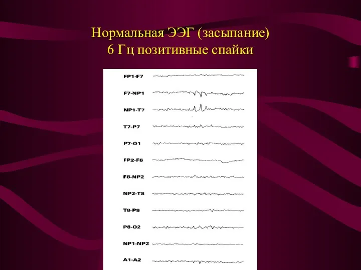 Нормальная ЭЭГ (засыпание) 6 Гц позитивные спайки