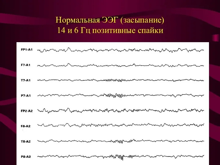 Нормальная ЭЭГ (засыпание) 14 и 6 Гц позитивные спайки