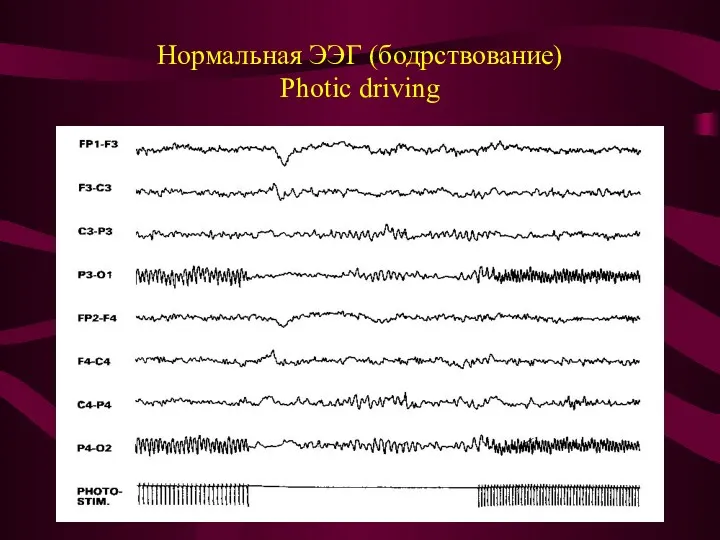 Нормальная ЭЭГ (бодрствование) Photic driving