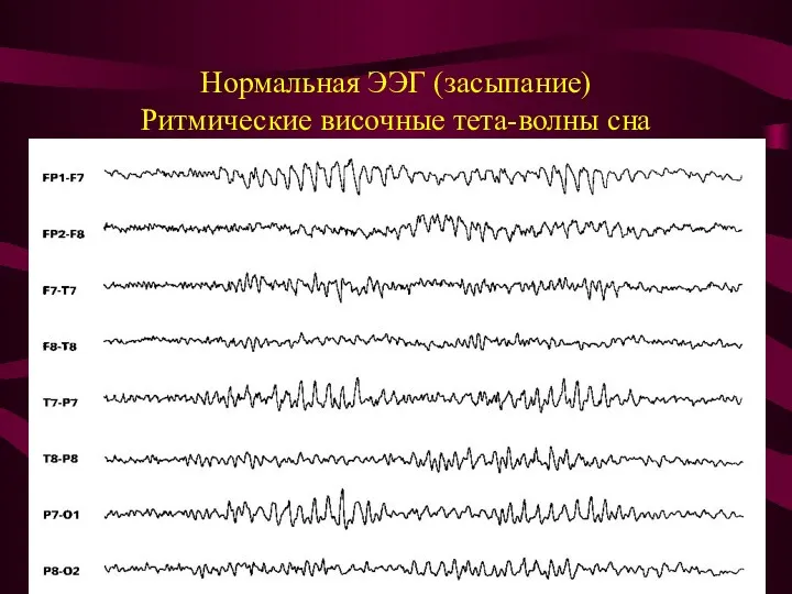 Нормальная ЭЭГ (засыпание) Ритмические височные тета-волны сна