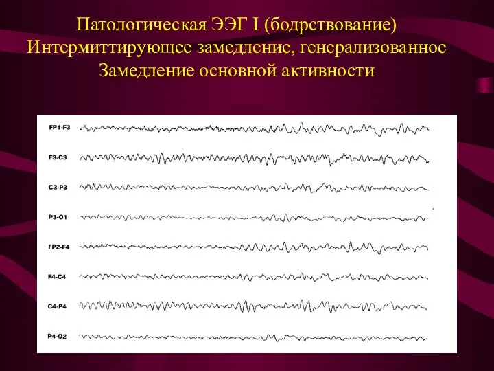 Патологическая ЭЭГ I (бодрствование) Интермиттирующее замедление, генерализованное Замедление основной активности