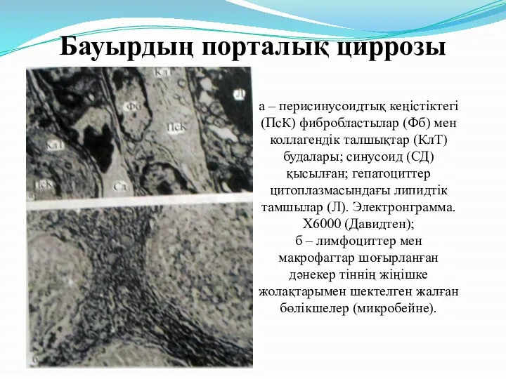 Бауырдың порталық циррозы а – перисинусоидтық кеңістіктегі (ПсК) фибробластылар (Фб)