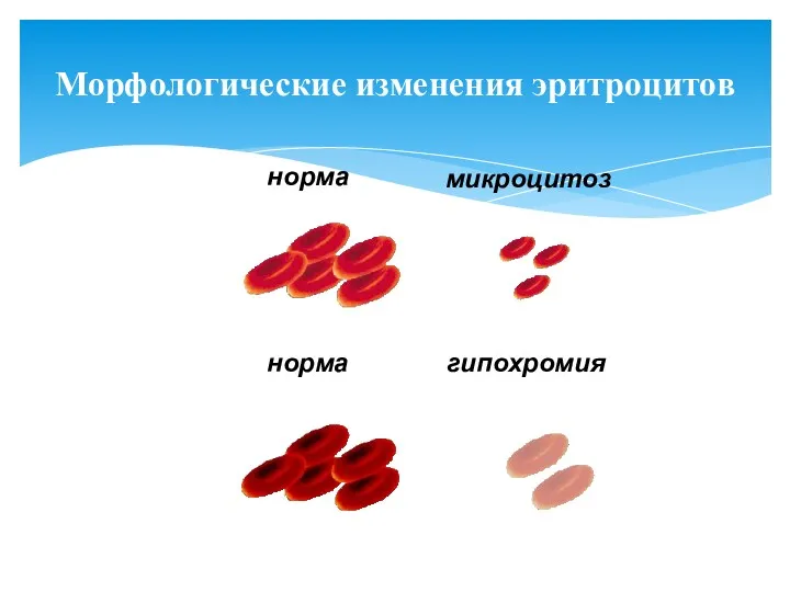 норма Морфологические изменения эритроцитов микроцитоз норма гипохромия