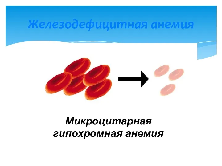 Микроцитарная гипохромная анемия это Железодефицитная анемия