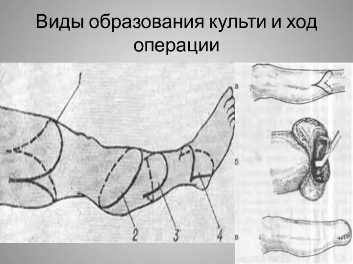 Виды образования культи и ход операции