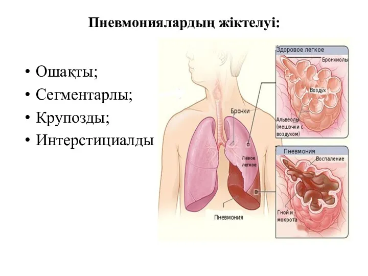 Пневмониялардың жіктелуі: Ошақты; Сегментарлы; Крупозды; Интерстициалды