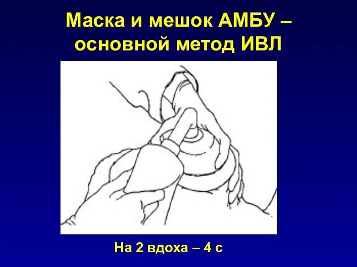 Маска и мешок АМБУ – основной метод ИВЛ На 2 вдоха – 4 с