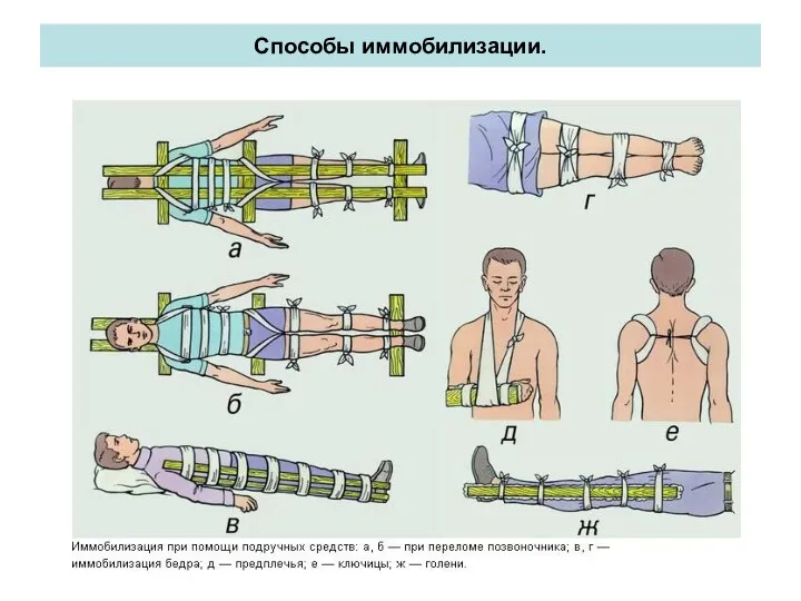 Способы иммобилизации.