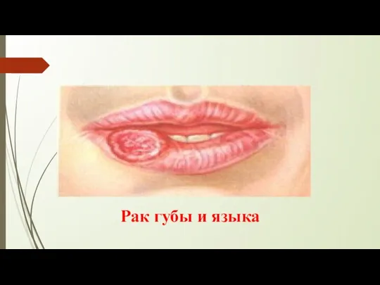 Рак губы и языка