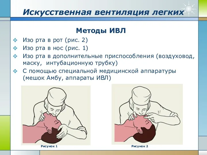 Искусственная вентиляция легких Методы ИВЛ Изо рта в рот (рис.