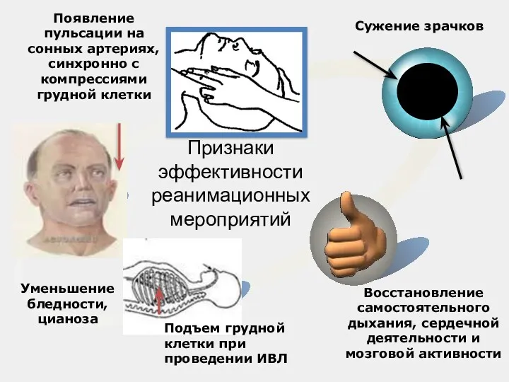 Признаки эффективности реанимационных мероприятий Появление пульсации на сонных артериях, синхронно