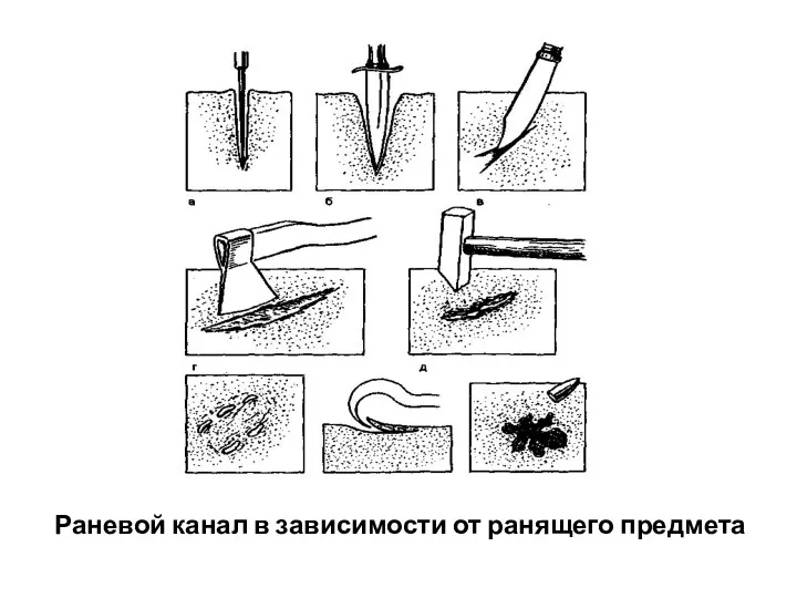 Раневой канал в зависимости от ранящего предмета