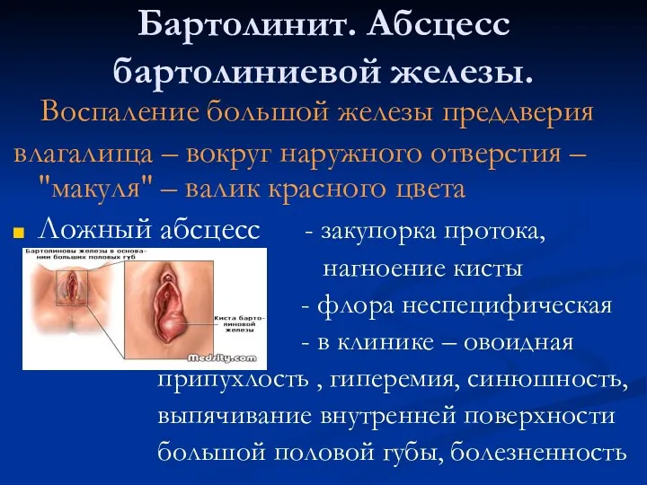 Бартолинит. Абсцесс бартолиниевой железы. Воспаление большой железы преддверия влагалища –