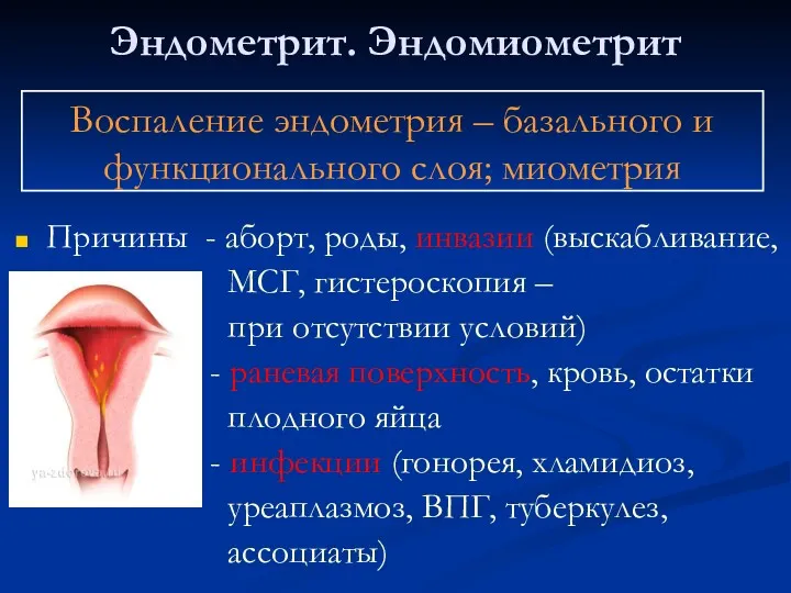 Эндометрит. Эндомиометрит Причины - аборт, роды, инвазии (выскабливание, МСГ, гистероскопия