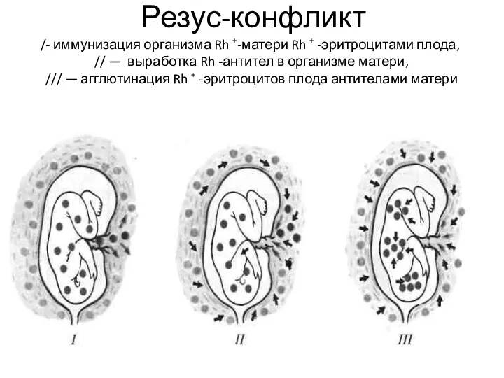 Резус-конфликт /- иммунизация организма Rh +-матери Rh + -эритроцитами плода,