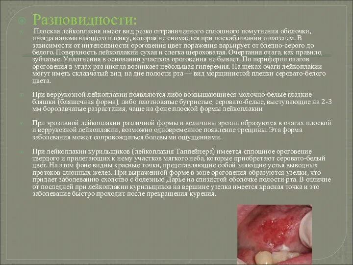 Разновидности: Плоская лейкоплакия имеет вид резко отграниченного сплошного помутнения оболочки,