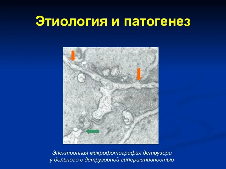 Этиология и патогенез Электронная микрофотография детрузора у больного с детрузорной гиперактивностью