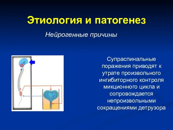 Этиология и патогенез Нейрогенные причины Супраспинальные поражения приводят к утрате