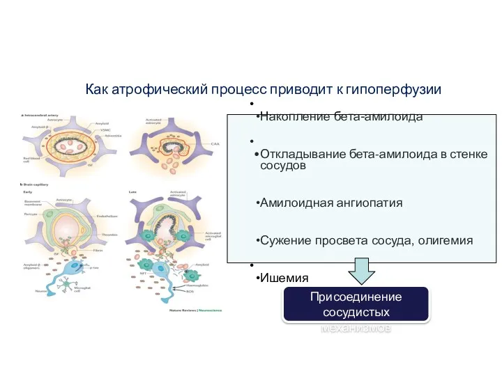 Как атрофический процесс приводит к гипоперфузии Накопление бета-амилоида Откладывание бета-амилоида