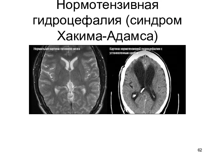 Нормотензивная гидроцефалия (синдром Хакима-Адамса)