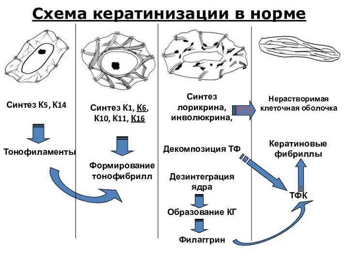 Схема кератинизации в норме Синтез К5, К14 Тонофиламенты Синтез К1,