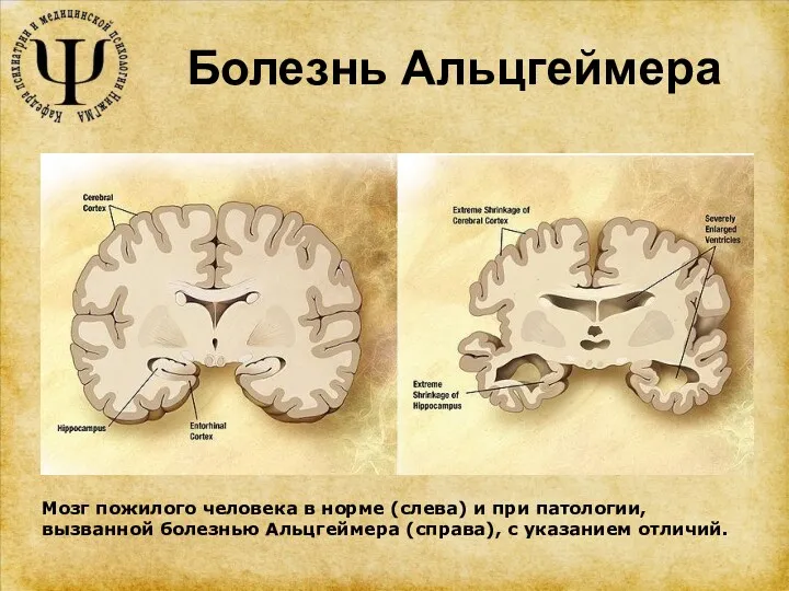 Болезнь Альцгеймера Мозг пожилого человека в норме (слева) и при