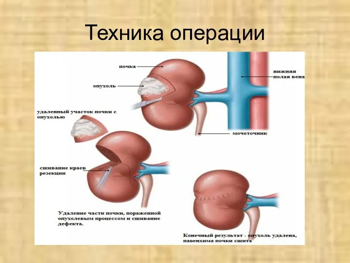 Техника операции