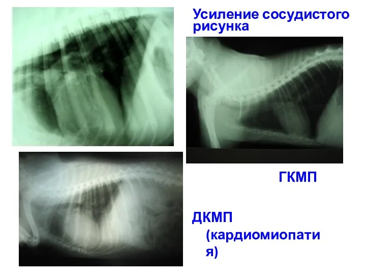 Усиление сосудистого рисунка ДКМП (кардиомиопатия) ГКМП