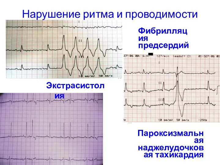 Нарушение ритма и проводимости Экстрасистолия Пароксизмальная наджелудочковая тахикардия Фибрилляция предсердий