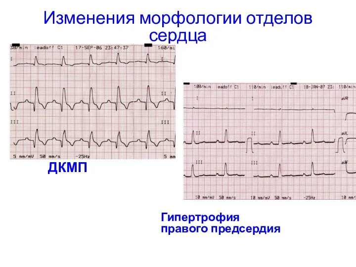 Изменения морфологии отделов сердца ДКМП Гипертрофия правого предсердия
