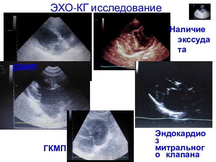 ЭХО-КГ исследование ДКМП Наличие экссудата Эндокардиоз митрального клапана ГКМП