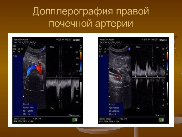 Допплерография правой почечной артерии