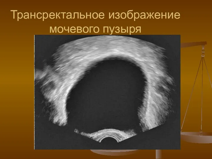 Трансректальное изображение мочевого пузыря