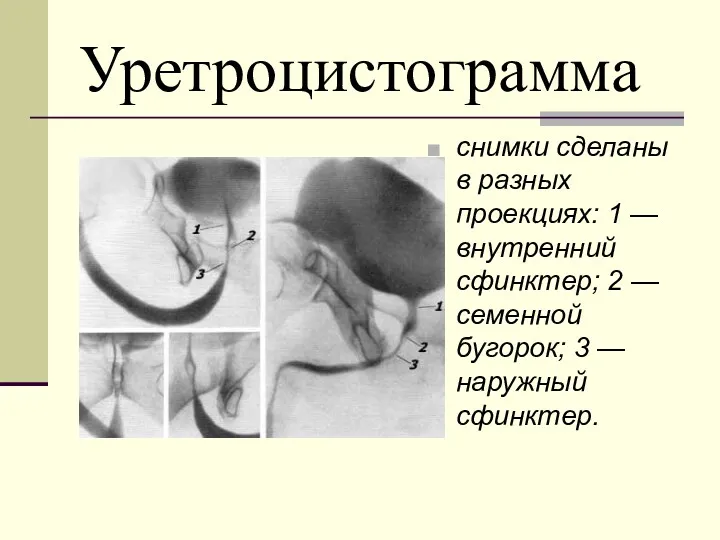 Уретроцистограмма снимки сделаны в разных проекциях: 1 — внутренний сфинктер;