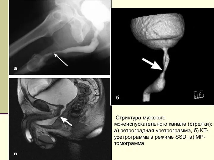 Стриктура мужского мочеиспускательного канала (стрелки): а) ретроградная уретрограмма, б) КТ-уретрограмма в режиме SSD; в) МР-томограмма