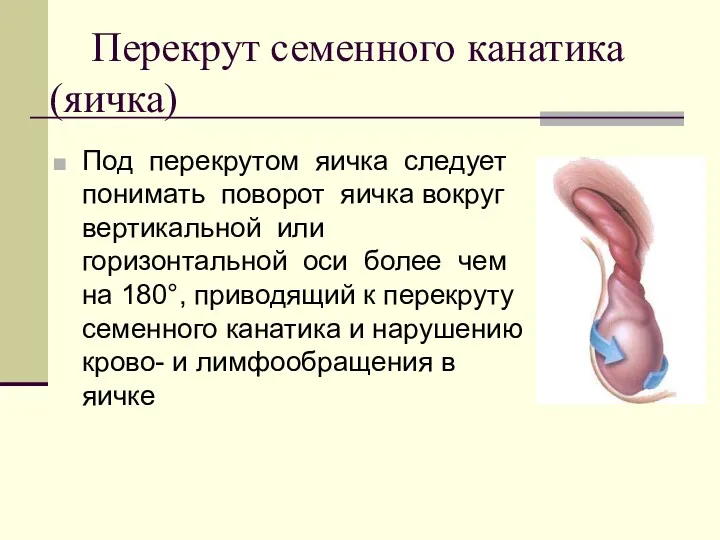 Перекрут семенного канатика (яичка) Под перекрутом яичка следует понимать поворот