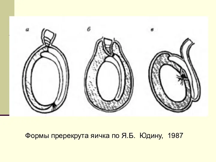 Формы пререкрута яичка по Я.Б. Юдину, 1987